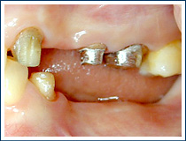全身疾患と歯周病の関係