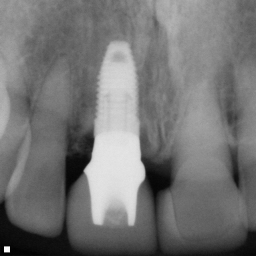 上顎中切歯の症例　　即時埋入