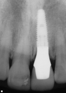 上顎中切歯の症例　　即時埋入＋エクストルージョン