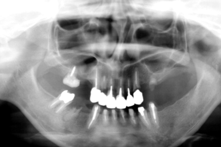 上顎臼歯の症例　　上顎洞底挙上（ソケットリフト）とインプラント