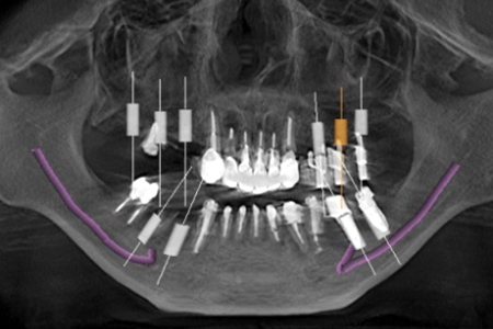 上顎臼歯の症例　　上顎洞底挙上（ソケットリフト）とインプラント