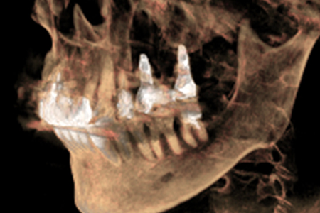 上顎結節の症例　　上顎結節へのインプラント