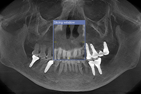 上顎結節の症例　　上顎結節へのインプラント
