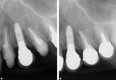 上顎前歯の症例　　CTからのサージカルガイド