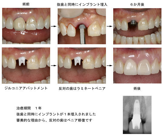 上顎中切歯の症例 抜歯即時埋入