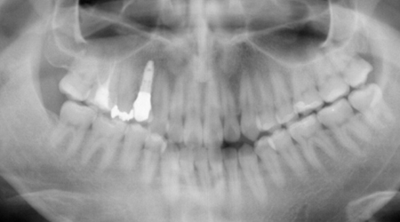 上顎の症例　骨造成(GBR)してインプラント