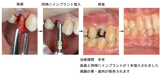 右上の症例 抜歯即時埋入