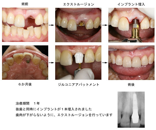 上顎中切歯の症例 抜歯即時埋入+エクストルージョン
