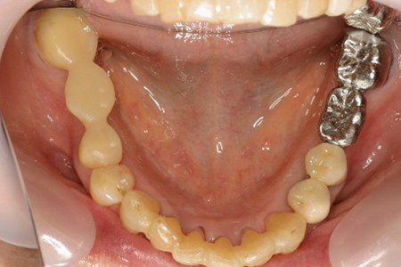 上下顎の症例　　　矯正して動揺歯を固定