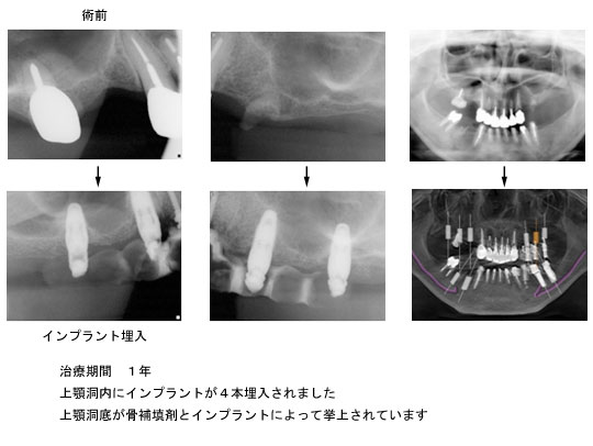 上顎の症例 骨造成(GBR)してインプラント