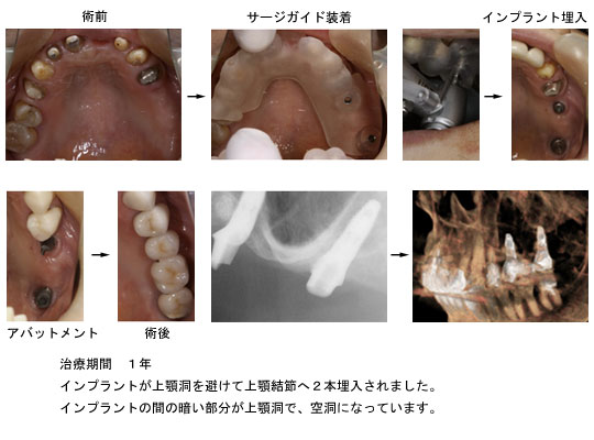 上顎臼歯の症例 上顎洞底挙上(ソケットリフト)とインプラント