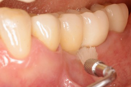 下顎の症例　　支台歯はセラミックアバットメント