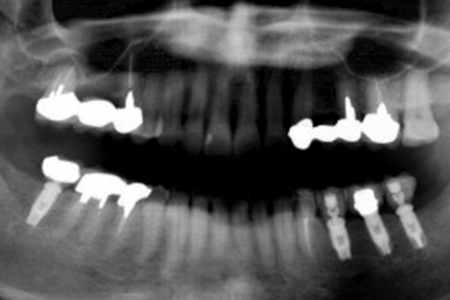 下顎の症例　　支台歯はセラミックアバットメント