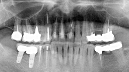 下顎の症例　　支台歯はメタルアバットメント