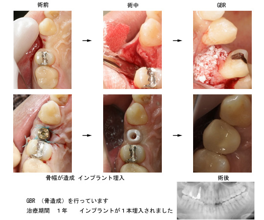 上顎前歯の症例 CTからの診断
