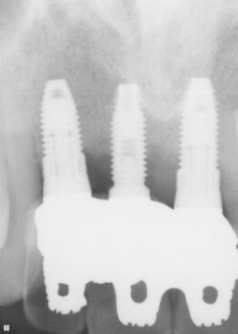 上顎前歯の症例　　オーバーデンチャー