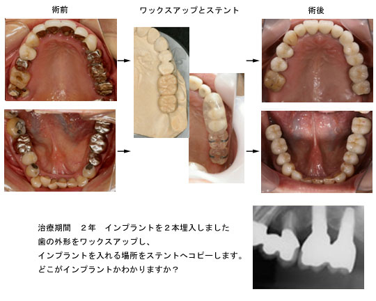 上顎の症例 埋入用ワックスアップ