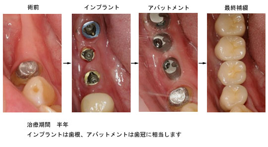 右下の症例 インプラントのパーツ