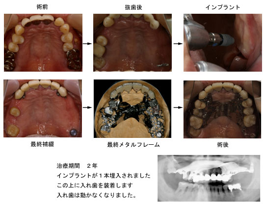 上顎結節の症例 オーバーデンチャー