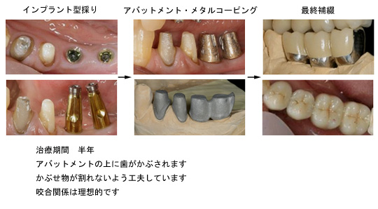 左下の症例 インプラントの型採り