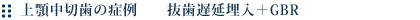 上顎中切歯の症例 抜歯遅延埋入+GBR