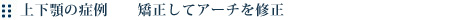 上下顎の症例 矯正してアーチを修正