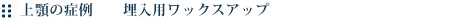 上顎の症例 埋入用ワックスアップ
