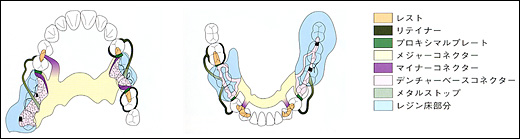 入れ歯の構成要素