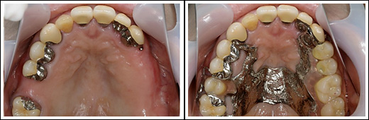 インプラントではなく入れ歯のほうが有効だと判断した症例