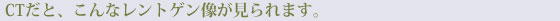 CTだと、こんなレントゲン像が見られます。