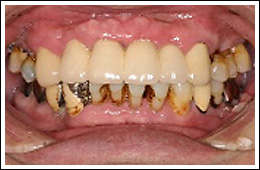 全身疾患と歯周病の関係
